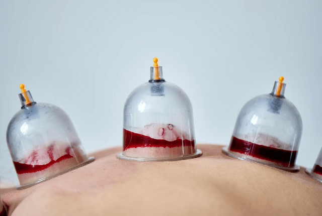 Top-rated Hijama services near you in San Francisco. Experience expert care in a welcoming environment for a revitalizing wellness experience